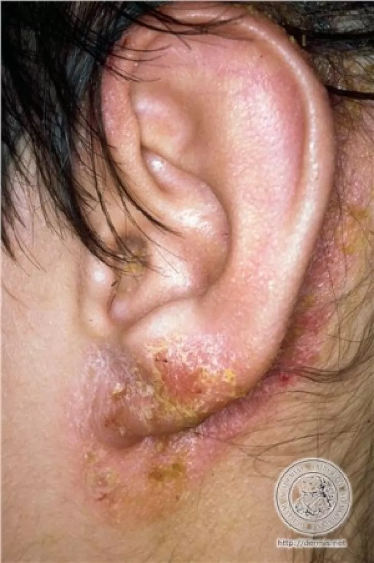 Afectiuni inflamatorii si parazitare ale urechii externe: furunculul, otita, eczema, otomicoza
