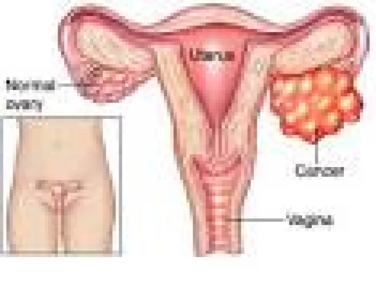Cancerul ovarian este diagnosticat anual la un sfert de milion de femei din intreaga lume