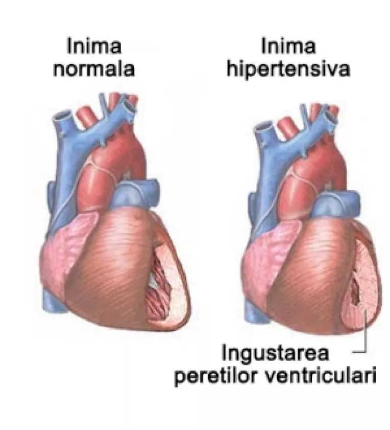 Cauza aparitiei hipertensiunii
