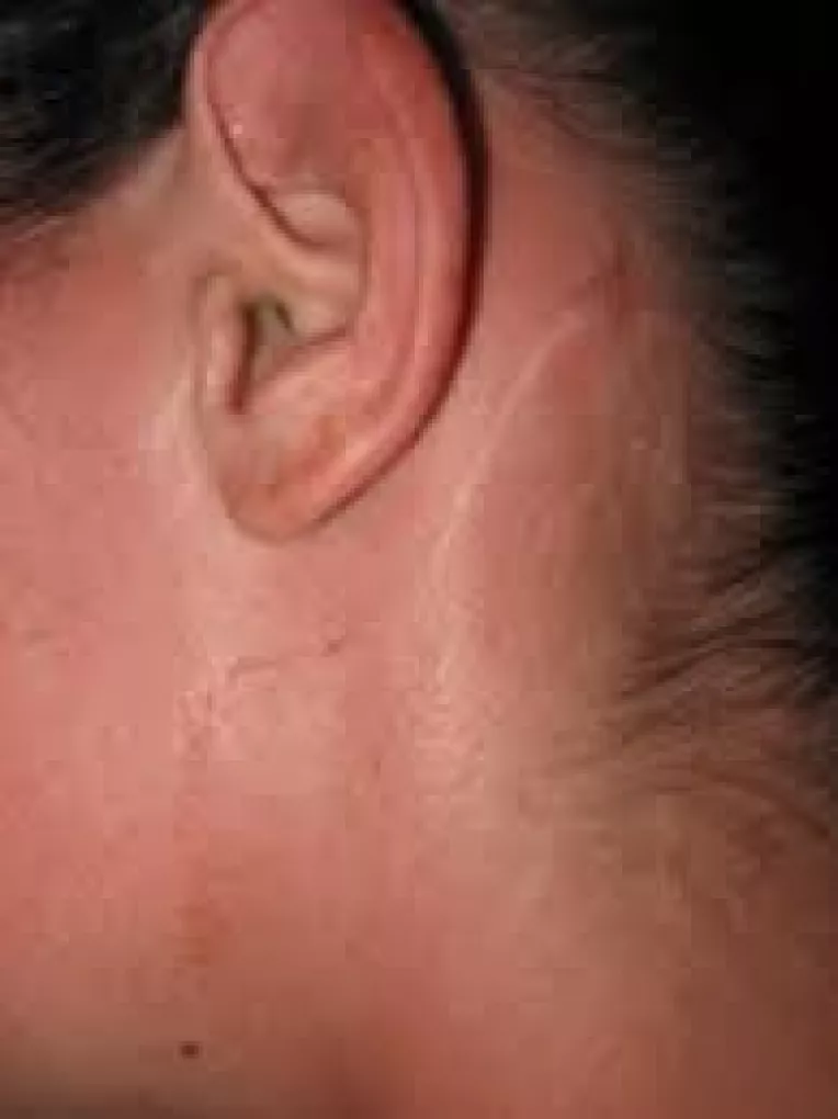 Cicatricele constituie o parte a procesului natural de vindecare 