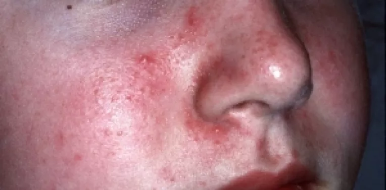 Dermatita seboreica, o afectiune cutanata caracterizata prin cruste (scuame) albicioase, unsuroase sau uscate