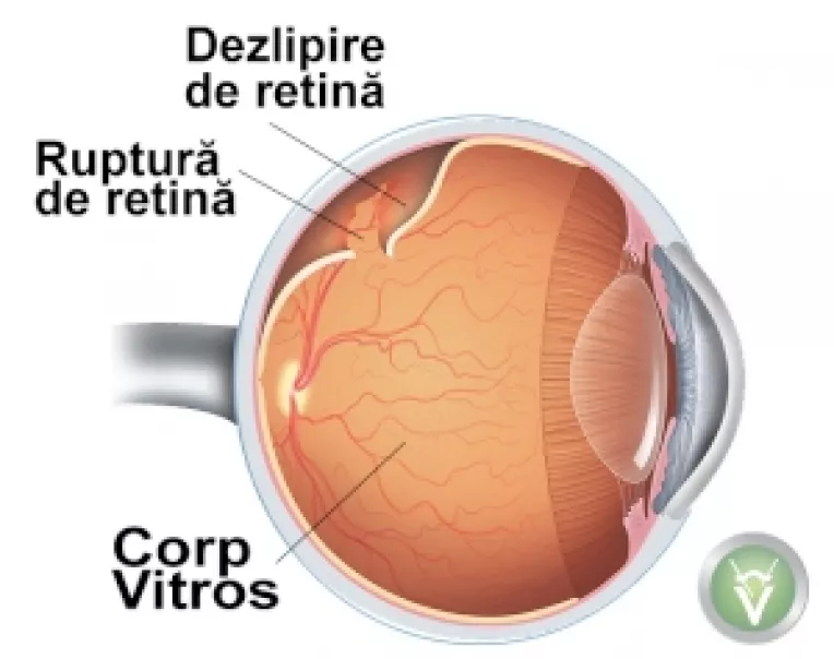 Interviu cu medicul oftalmolog Babara Stela Efimovna: Dezlipirea de retina - o boala periculoasa