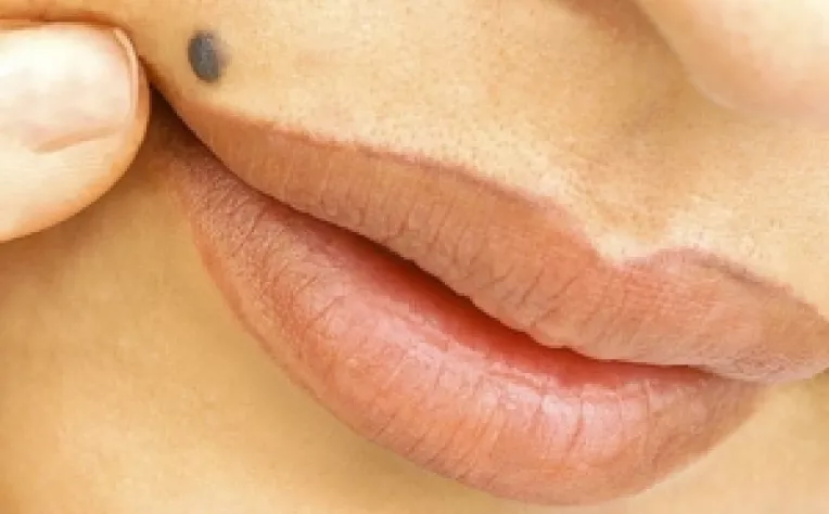 Metode de indepartare a alunitelor, semnelor din nastere si urmelor de pe piele 