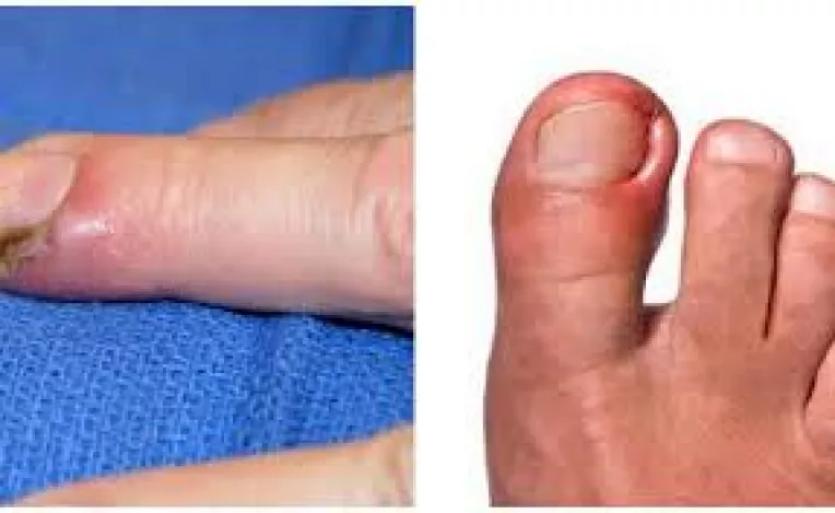 Panaritiu de la unghiile degetelor se trateaza cu baneocin, apa oxigenata si betadina