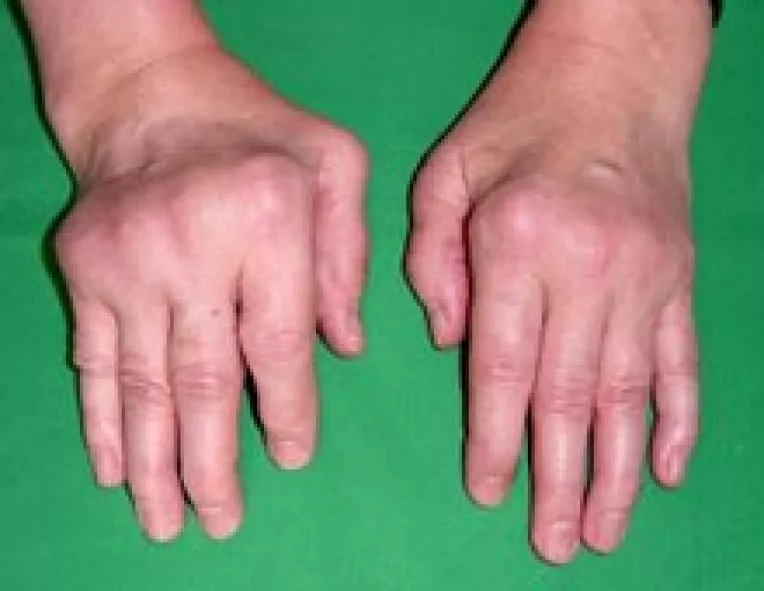 Poliartrita reumatoida apare din cauza unor probleme de imunitate