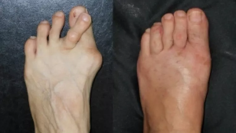 Poliartrita reumatoida, o boala care afecteaza articulatiile mainilor si picioarelor 