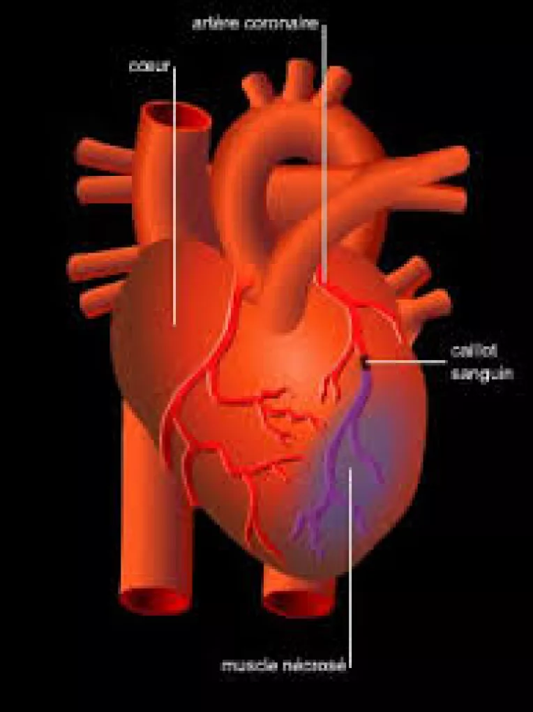 Simptomele unui atac de cord