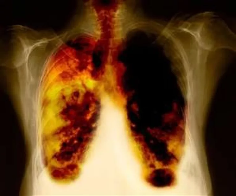 Top 10 intrebari despre cancerul pulmonar